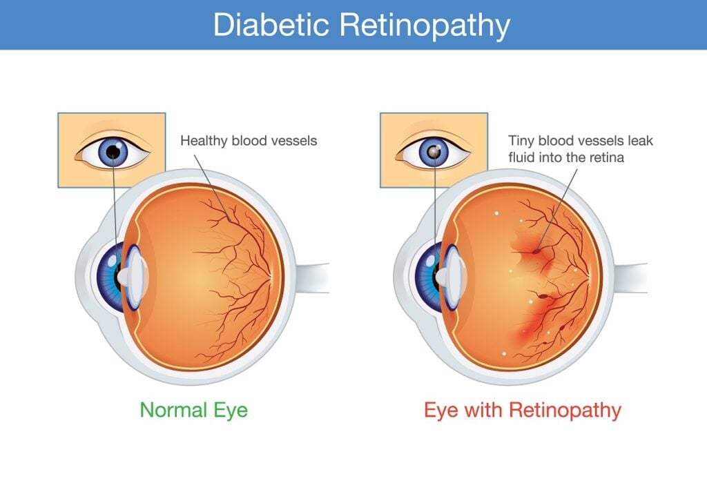 اعتلال شبكية العين Retinopathy امراض تصيب شبكية العين مؤدية الى اضطراب ...